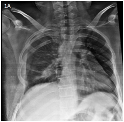 <strong>Figure 1A </strong> Chest X-ray with absence of 5,6 and 7 right costal arcs with dorsal dextroescoliosis.
