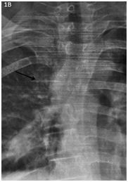 <strong>Figure 1B </strong> T4 listhesis (black arrow).