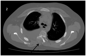 <strong>Figure 2 </strong> Thorax CT scan Axial view. showing T4 listhesis (arrow). Right pleural effusion is observed.