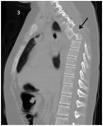 <strong>Figure 3 </strong> Thorax CT scan Sagital view showing T4 listhesis (black arrow).