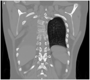 <strong>Figure 4 </strong> Thorax CT scan coronal view. Right pleural effusion and absence of 5, 6 and 7 right costal arcs.