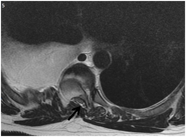 <strong>Figure 5 </strong> Magnetic Resonance Imaging, axial acquisition enhanced in T2. Spinal canal stenosis with spinal cord compression (black arrow).