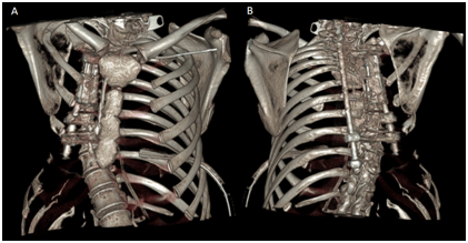 <strong>Figure 6 </strong> 3D tomographic reconstruction showing progression of the disease characterized by absence of right rib cage. A) Anteroposterior view. B) Posteroanterior view. 