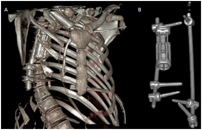 <strong>Figure 7 </strong> Presence of osteosynthesis material in the dorsal column for correction of dorsal scoliosis in 3D reconstruction. B) 3D tomographic reconstruction osteosynthesis material used. 